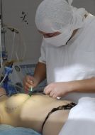 Операция по увеличению груди