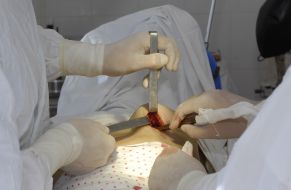 Операция по увеличению груди