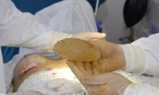 Операция по увеличению груди