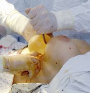 Операция по увеличению груди