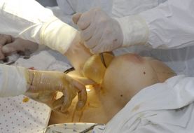 Операция по увеличению груди