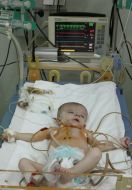 Child’s cardiologic reanimation separation