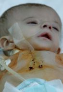 Child’s cardiologic reanimation separation