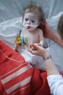 Little girl after heart surgery