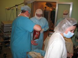 The operation on liver transplantation