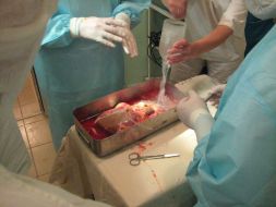 The operation on liver transplantation