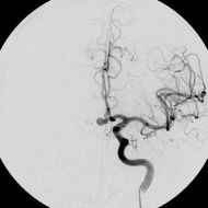 Arteriogram