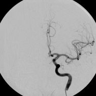 Arteriogram