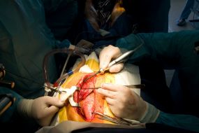 Coronary artery bypass surgery