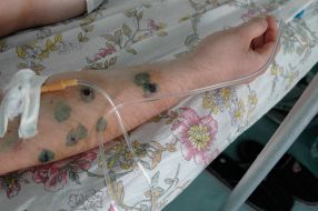 The hand of participant of nightly assault of cognac factory ”Tavriya”