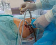 Surgeons carry out hip arthroscopy