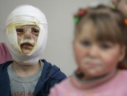 Patients of burn center