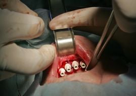 Implantation of implant