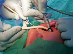 Implantation of implant