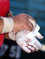Blood blister on the palm of a strongman