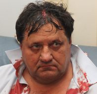 Nikolay Petruk with the broken head