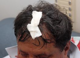 Nikolay Petruk with the broken head