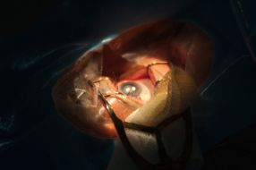 Операція з видалення катаракти