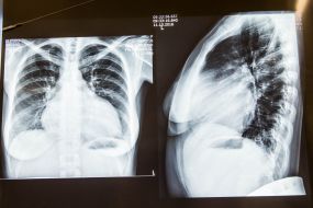 X-rays in the operating room