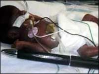 Врачи спасли новорожденного ребенка весом 284 грамма (фото)