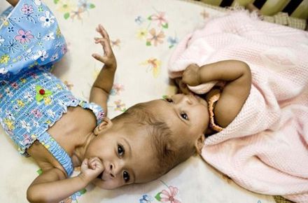 Британские хирурги успешно разделили сиамских близнецов (фото)