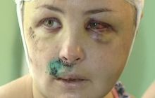 Опозиція вимагає перевірити, чому лікар побачив лише «легкі тілесні» у Крашкової