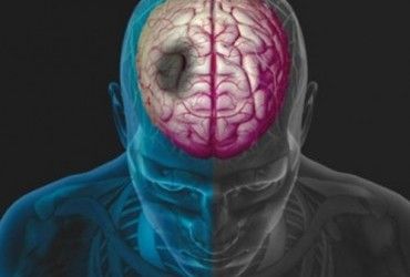 Вчені з'ясували, що у мозку є два тижні на самовідновлення після інсульту