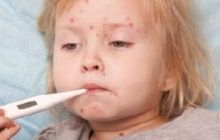 Перенесенная корь ослабляет иммунитет ребенка на 2-3 года