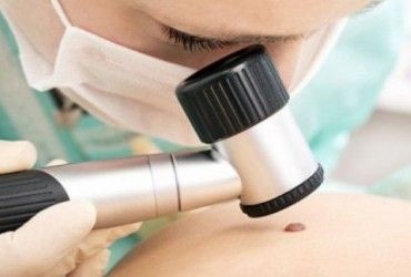 Будьте пильні: Комаровський розповів, як розпізнати меланому (відео)