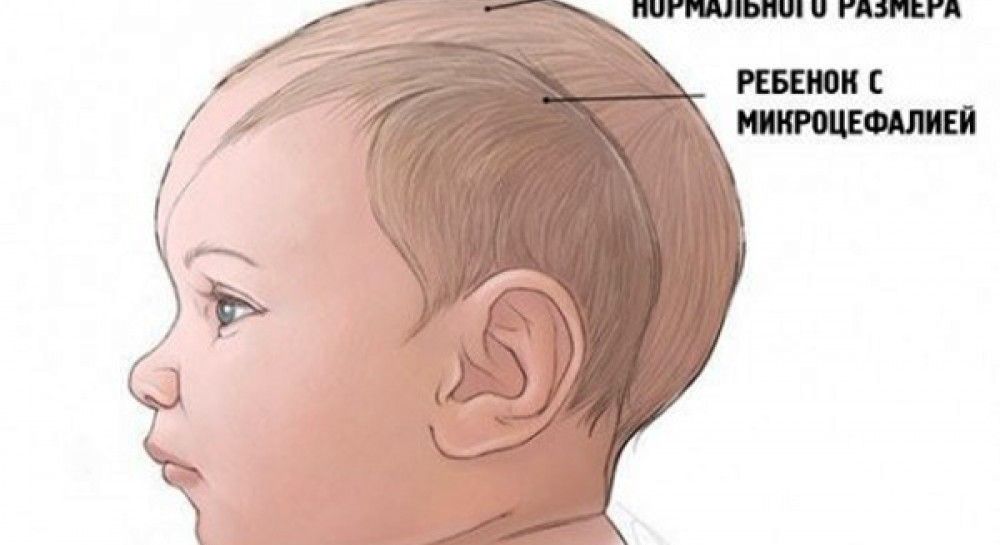 Голова в 1 год. Микроцефалия форма черепа. Нормальная форма головы у ребенка. Микроцефальная форма головы у ребенка. Форма головы у ребенка в год.