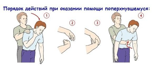 Прийом Геймліха Прийом Геймліха