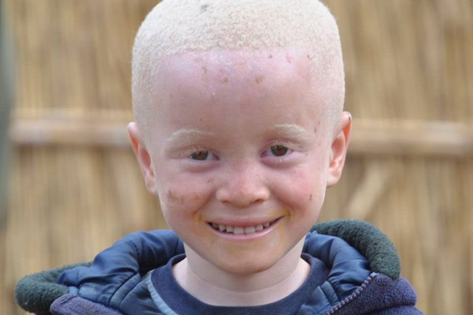 13 июня - Международный день распространения информации об альбинизме / фото ООН
