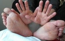 У детей из столичного детсада №62 выявлены симптомы вируса Коксаки