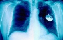 FDA отзывает почти 500 тысяч кардиостимуляторов из-за риска дистанционных кибератак