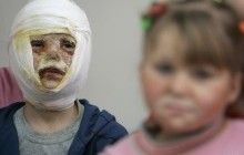 Сметана й олія не допоможуть: Супрун розповіла, що робити при опіках (інфографіка)