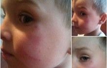 "Дитина лежить й тримається за щоку": з'явилися подробиці побиття хлопчика у дитсадку на Київщині (фото)