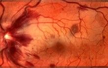 Киевляне завтра могут бесплатно обследоваться относительно тромбоза: адреса