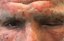 Аргентинский футболист почти потерял зрение во время запуска новогодних фейерверков