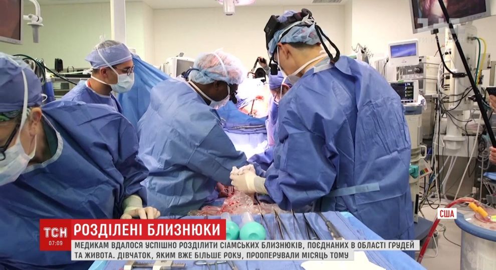 В США проведена операция по разделению сиамских близнецов, которые срослись головами (видео) В США проведена операция по разделению сиамских близнецов, которые срослись головами (видео)