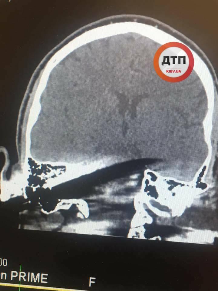 Ніж вдалося витягти під час другої операції / фото facebook.com/dtp.kiev.ua Ніж вдалося витягти під час другої операції / фото facebook.com/dtp.kiev.ua
