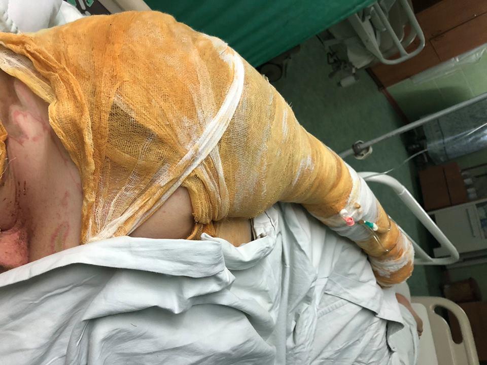 Гандзюк знаходиться у важкому, але стабільному стані / Фото facebook.com/MasiNayyem