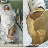 Появились больничные фото пострадавшей от атаки с кислотой херсонской активисткы