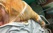 Активистка, которую в Херсоне облили кислотой, рассказала, сколько стоит нападение