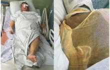 Облитая кислотой херсонская активистка Гандзюк перенесла 11 операций и до сих пор находится в реанимации
