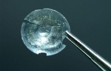 Лікарі знайшли у жінки з пухлиною на повіці застряглу 28 років тому контактну лінзу