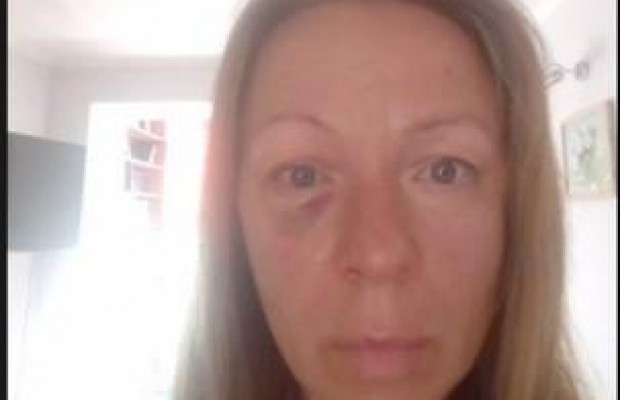 Побита актором серіалу "Свати" киянка в прямому ефірі розповіла про свій стан