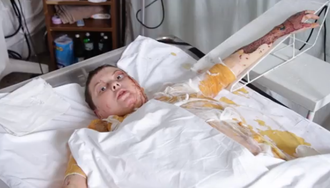 Екатерина Гандзюк получила химический ожог более 30% тела / скриншот с видео