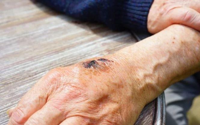 В Одесской области зафиксирована сибирская язва / фото clinicportal.ru