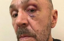Избили?: лидер группы "Ленинград" Сергей Шнуров ворвался обратно в Instagram, сияя фингалом (фото)