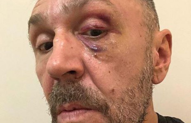 Побили?: лідер гурту "Ленінград" Сергій Шнуров увірвався назад в Instagram із підбитим оком (фото)